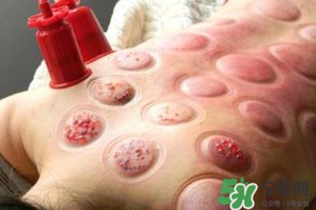 拔罐放血對(duì)身體好嗎？拔罐放血有什么好處？