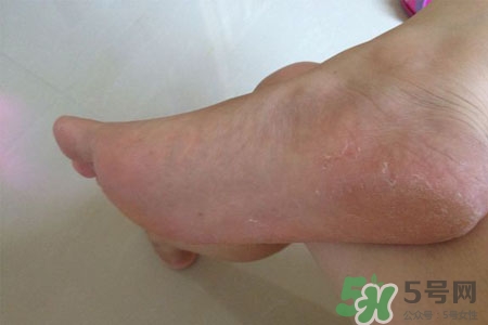 腳趾經(jīng)常抽筋是缺鈣嗎？腳趾抽筋是什么原因？