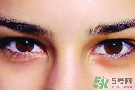 眼睛哭腫了怎么辦？眼睛哭腫了如何快速消腫？
