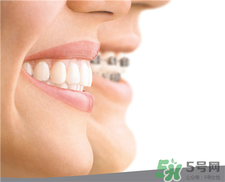 帶隱適美可以吃飯嗎?帶隱適美怎么吃飯? 帶隱適美可以吃飯嗎?帶隱適美怎么吃飯?