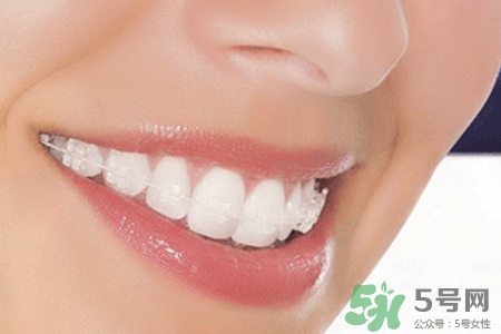 隱形牙套矯正多少錢？隱形牙套多少錢一副？