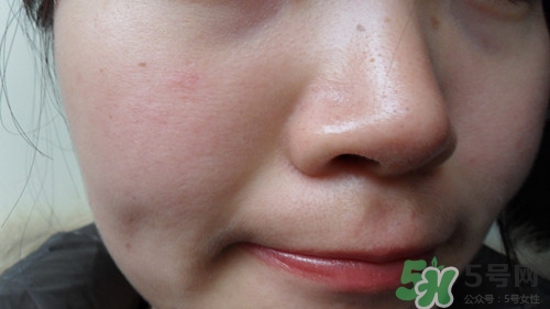 黑色痘印怎么消除小妙招?黑色痘印會自己消失嗎 黑色痘印怎么消除小妙招?黑色痘印會自己消失嗎