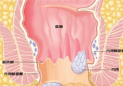 怎樣辨別外痔和內(nèi)痔？外痔和內(nèi)痔的區(qū)別