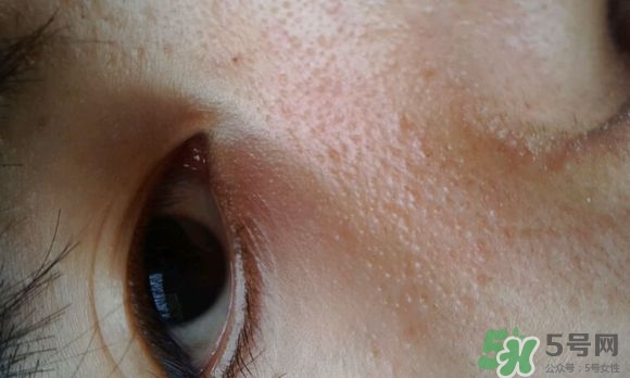 眼霜可以去除脂肪粒嗎?眼霜可以消除脂肪粒嗎? 眼霜可以去除脂肪粒嗎?眼霜可以消除脂肪粒嗎?