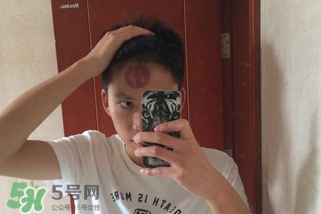 拔罐后皮膚癢能撓嗎？拔罐后身上癢切忌抓撓