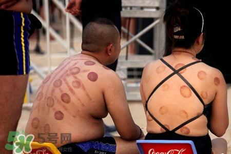 針灸火罐后多久能洗澡？針灸火罐后能馬上洗澡嗎？