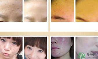 伊詩蘭頓祛痘怎么樣？伊詩蘭頓祛痘膏有用嗎？