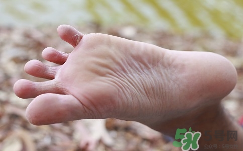 腳氣會(huì)傳染嗎?腳氣可以傳染到手上嗎? 腳氣會(huì)傳染嗎?腳氣可以傳染到手上嗎?