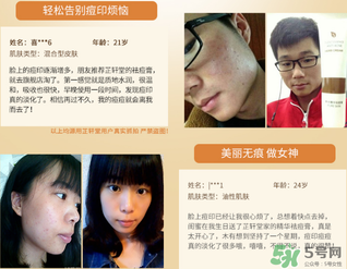 芷軒堂祛痘有效果嗎？芷軒堂祛痘印效果怎么樣？