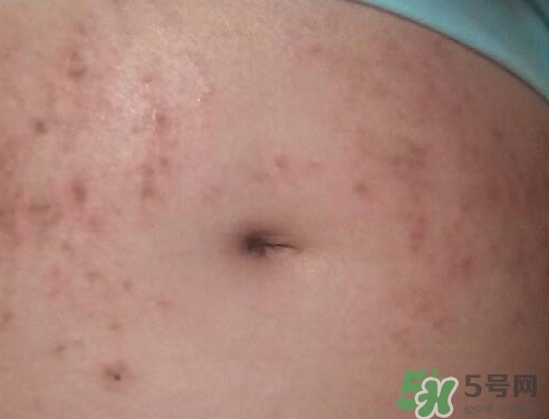 懷孕6個月肚子上長紅點點是怎么回事? 懷孕6個月肚子上長紅點點是怎么回事?