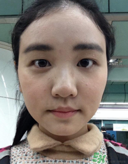 埋線雙眼皮的危害_埋線雙眼皮有風險后遺癥嗎