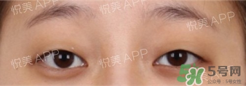 埋線雙眼皮多久恢復(fù)自然？埋線雙眼皮多久能恢復(fù)
