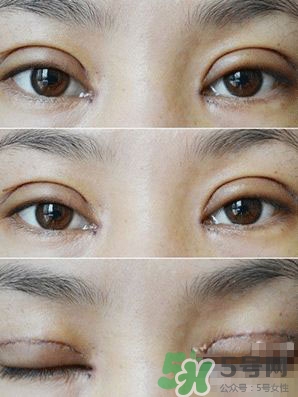 定點(diǎn)雙眼皮恢復(fù)過(guò)程圖_定點(diǎn)雙眼皮要多久恢復(fù) 定點(diǎn)雙眼皮恢復(fù)過(guò)程圖_定點(diǎn)雙眼皮要多久恢復(fù)