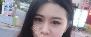 定點雙眼皮能保持多久？定點雙眼皮是永久的嗎？