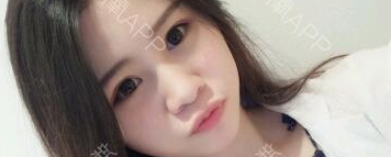 定點雙眼皮能保持多久？定點雙眼皮是永久的嗎？