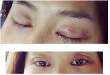 定點(diǎn)雙眼皮怎么做？定點(diǎn)雙眼皮需要拆線嗎？