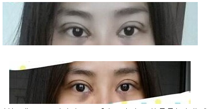 定點(diǎn)雙眼皮怎么做？定點(diǎn)雙眼皮需要拆線嗎？
