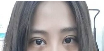 定點(diǎn)雙眼皮怎么做？定點(diǎn)雙眼皮需要拆線嗎？