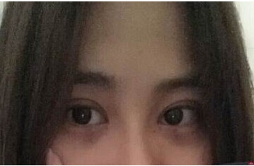 定點(diǎn)雙眼皮怎么做？定點(diǎn)雙眼皮需要拆線嗎？