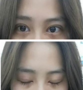 定點(diǎn)雙眼皮怎么做？定點(diǎn)雙眼皮需要拆線嗎？