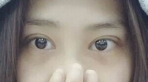 定點(diǎn)雙眼皮怎么做？定點(diǎn)雙眼皮需要拆線嗎？