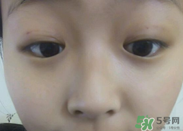 埋線雙眼皮需要拆線嗎？埋線雙眼皮怎么拆線