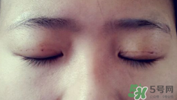 埋線雙眼皮需要拆線嗎？埋線雙眼皮怎么拆線