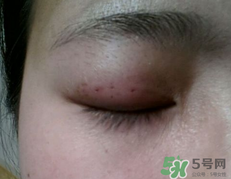 埋線雙眼皮需要拆線嗎？埋線雙眼皮怎么拆線