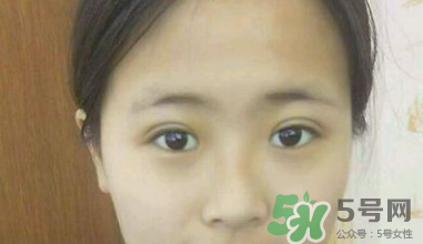 埋線雙眼皮需要拆線嗎？埋線雙眼皮怎么拆線