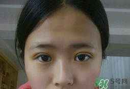 埋線雙眼皮需要拆線嗎？埋線雙眼皮怎么拆線