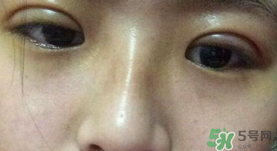 埋線雙眼皮需要拆線嗎？埋線雙眼皮怎么拆線