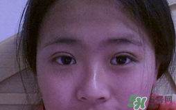 埋線雙眼皮需要拆線嗎？埋線雙眼皮怎么拆線