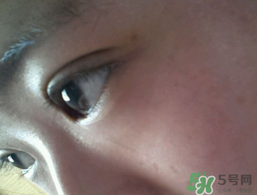 埋線雙眼皮需要拆線嗎？埋線雙眼皮怎么拆線