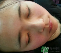 埋線雙眼皮需要拆線嗎？埋線雙眼皮怎么拆線