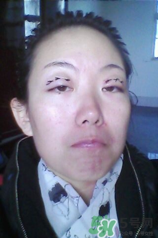 什么是定點雙眼皮？定點雙眼皮多少錢？