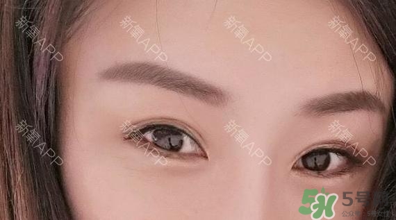 埋線雙眼皮能保持多久？埋線雙眼皮是永久嗎