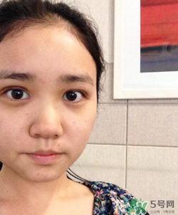 埋線雙眼皮的危害_埋線雙眼皮有風險后遺癥嗎