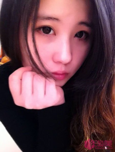 三點雙眼皮恢復過程圖_韓式三點雙眼皮多久恢復自然