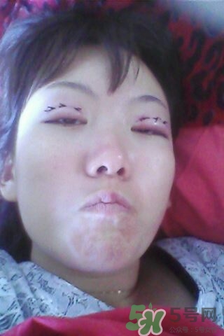 什么是定點雙眼皮？定點雙眼皮多少錢？