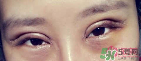 切開雙眼皮多久消腫？切開雙眼皮多久恢復(fù)？