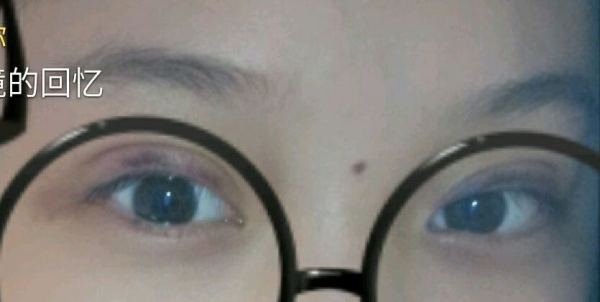 定點(diǎn)雙眼皮恢復(fù)過(guò)程圖_定點(diǎn)雙眼皮要多久恢復(fù) 定點(diǎn)雙眼皮恢復(fù)過(guò)程圖_定點(diǎn)雙眼皮要多久恢復(fù)