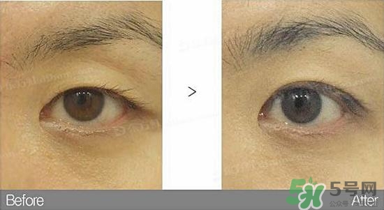 埋線雙眼皮需要拆線嗎？埋線雙眼皮怎么拆線