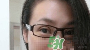 定點(diǎn)雙眼皮恢復(fù)過(guò)程圖_定點(diǎn)雙眼皮要多久恢復(fù) 定點(diǎn)雙眼皮恢復(fù)過(guò)程圖_定點(diǎn)雙眼皮要多久恢復(fù)