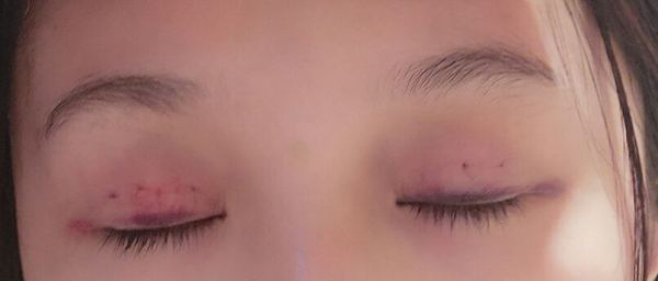 定點(diǎn)雙眼皮恢復(fù)過(guò)程圖_定點(diǎn)雙眼皮要多久恢復(fù) 定點(diǎn)雙眼皮恢復(fù)過(guò)程圖_定點(diǎn)雙眼皮要多久恢復(fù)