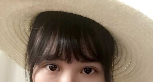 定點(diǎn)雙眼皮恢復(fù)過程圖_定點(diǎn)雙眼皮要多久恢復(fù)