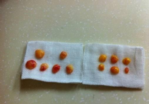 韓式三點(diǎn)雙眼皮是永久嗎？三點(diǎn)雙眼皮能保持多久？