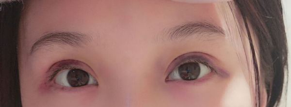 定點(diǎn)雙眼皮恢復(fù)過(guò)程圖_定點(diǎn)雙眼皮要多久恢復(fù) 定點(diǎn)雙眼皮恢復(fù)過(guò)程圖_定點(diǎn)雙眼皮要多久恢復(fù)