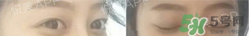 埋線雙眼皮多久恢復(fù)自然？埋線雙眼皮多久能恢復(fù)