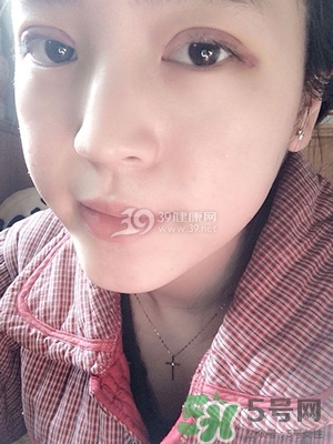 什么是定點雙眼皮？定點雙眼皮多少錢？