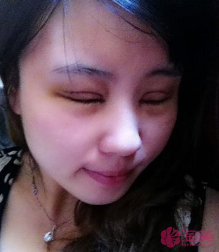 三點雙眼皮恢復過程圖_韓式三點雙眼皮多久恢復自然